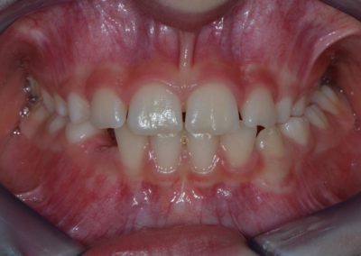Ortodonzia intercettiva prima