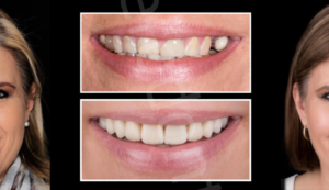 DIGITAL SMILE DESIGN SIMULATION