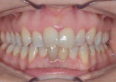 Ortodonzia invisibile prima