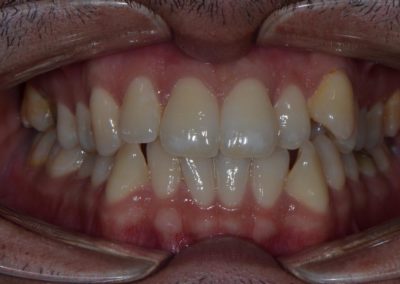 Ortodonzia tradizionale prima